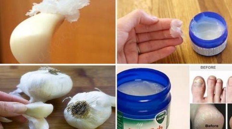 Absence au travail Alimentation Santé Experts Médecine alternative Remèdes maison rhume Vicks VapoRub 