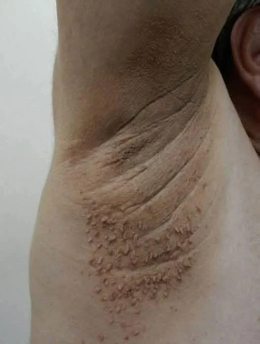 Cicatrices chéloïdes : causes, risques et traitements disponibles