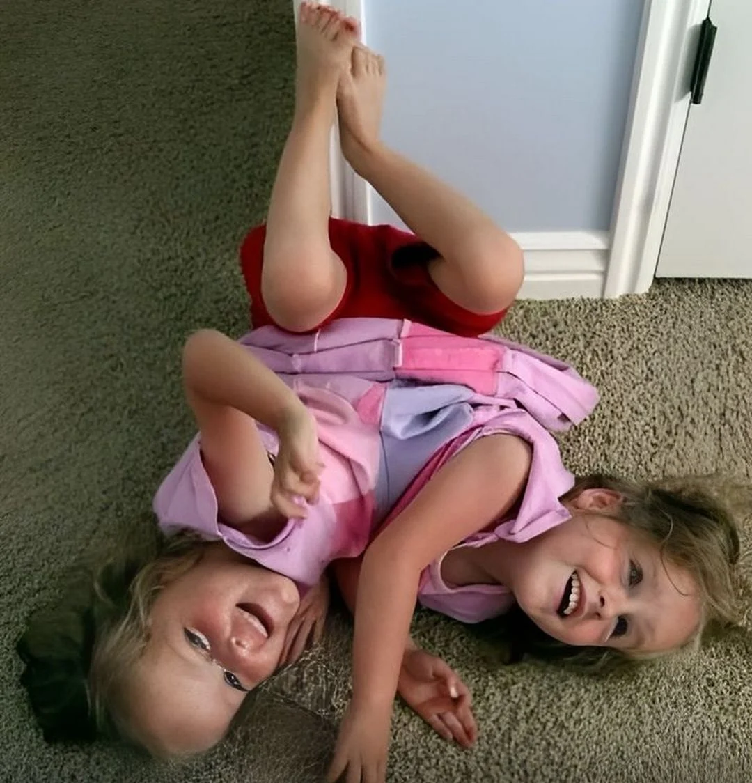 Les sœurs siamoises ont été séparées à l'âge de 4 ans. Elles ont aujourd'hui 20 ans et sont complètement...😵 😱👇 Voir plus