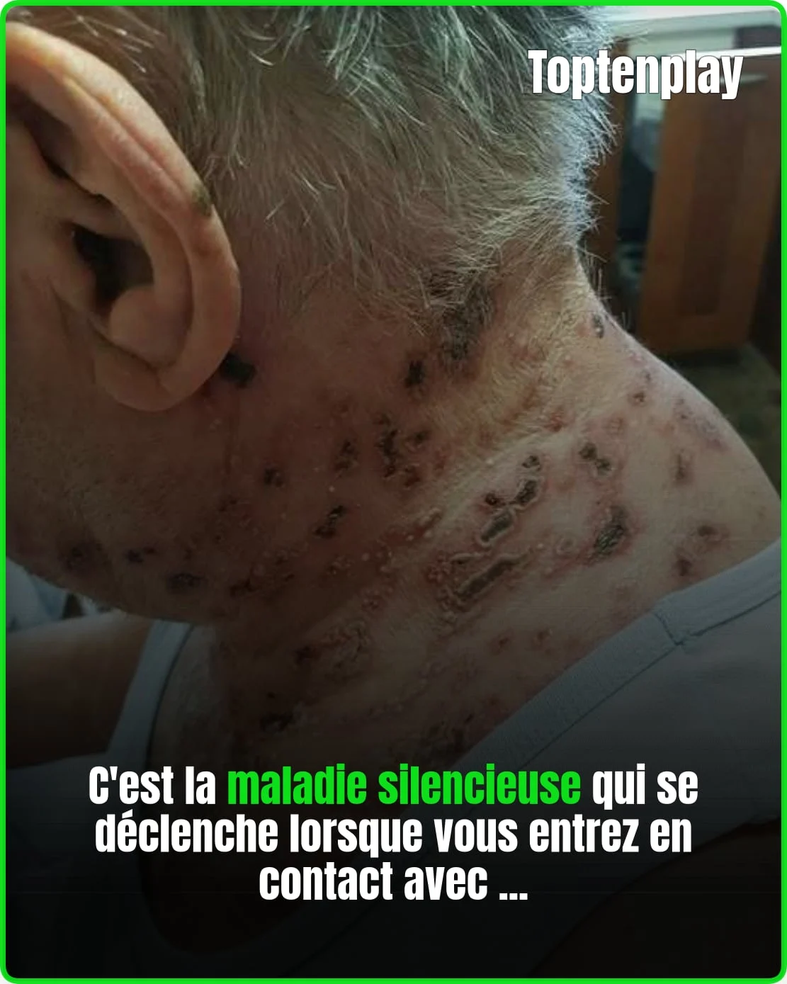 Le zona : comprendre ce virus silencieux qui sommeille en nous