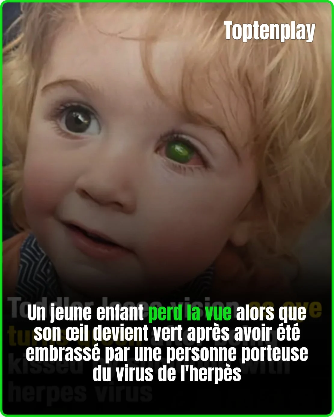 Un herpès transmis par un baiser rend un enfant aveugle d&rsquo;un œil