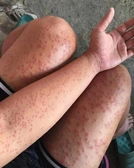 Urticaire et gêne respiratoire : quand la peau annonce une urgence vitale