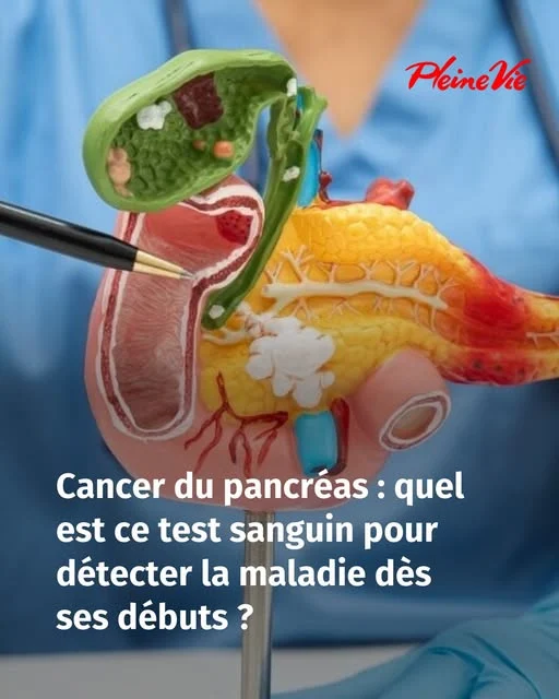 Cancer du pancréas: un test sanguin 6 fois plus efficace pour le détecter tôt